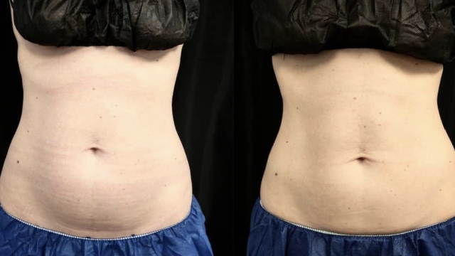 Freeze Away Fat with Coolsculpting: A Cool Solution for Stubborn Pounds