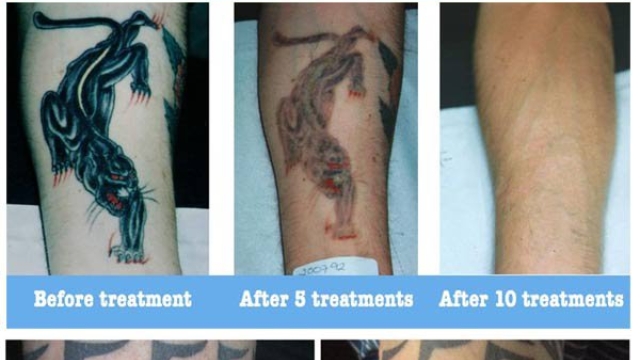 How Are You Able To Remove A Tattoo Nicely?