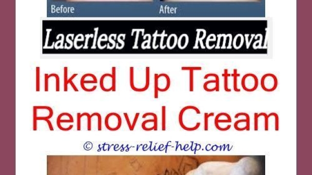 Risks Of Laser Tattoo Removal