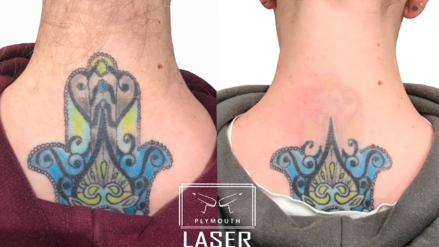 At Home Tattoo Removal As A Substitute For Expensive Laser Removal Methods