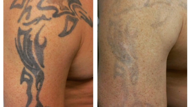 Tattoo Removal Costs – Finding A Cost-Effective Way To Obtain Rid Of Your Tattoo